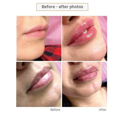 ajoure lips correction before and after