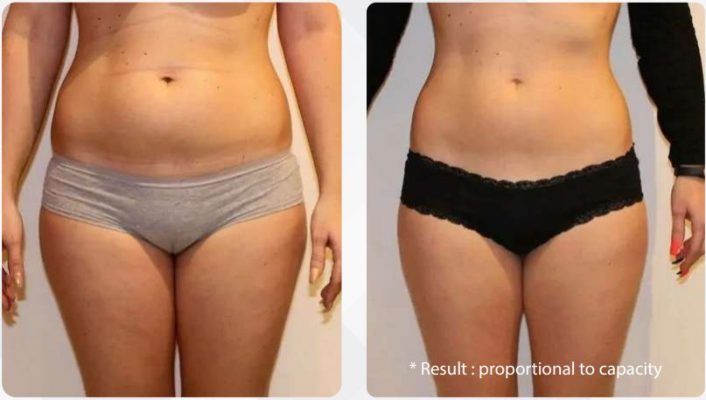 barbie slim before and after body