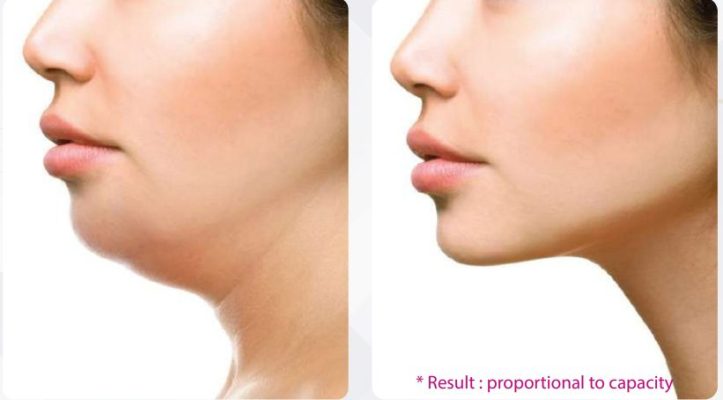 barbie slim before and after face